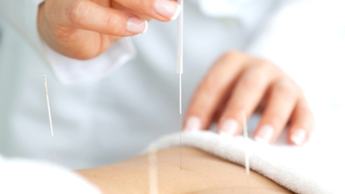 A photograph of a person performing acupuncture.